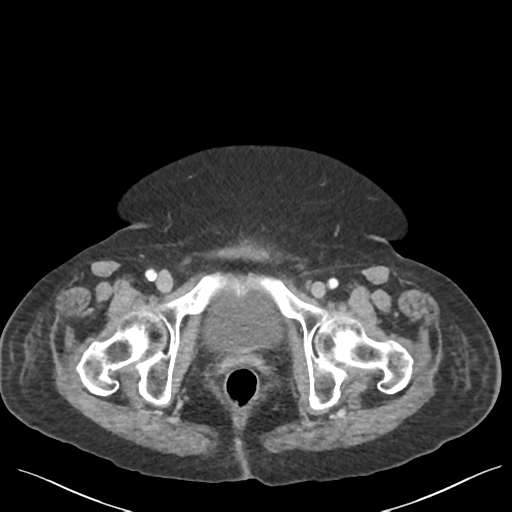 Cannonball metastases from endometrial cancer (Radiopaedia 42003-45031 E 74).png