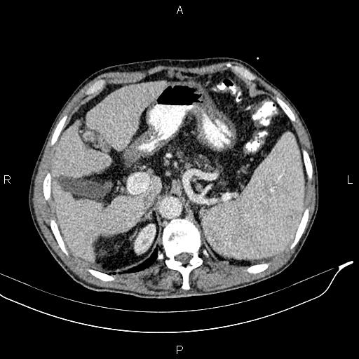 File:Caput medusae sign - portal hypertension (Radiopaedia 64007-72759 A 18).jpg