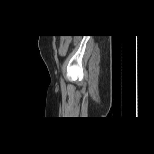 File:Carcinoma cervix- brachytherapy applicator (Radiopaedia 33135-34173 D 7).jpg