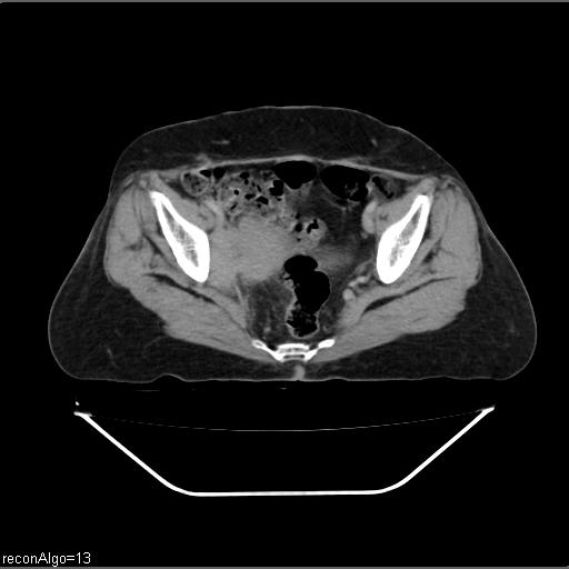 Carcinoma cervix- recurrence (Radiopaedia 34702-36137 B 45).jpg