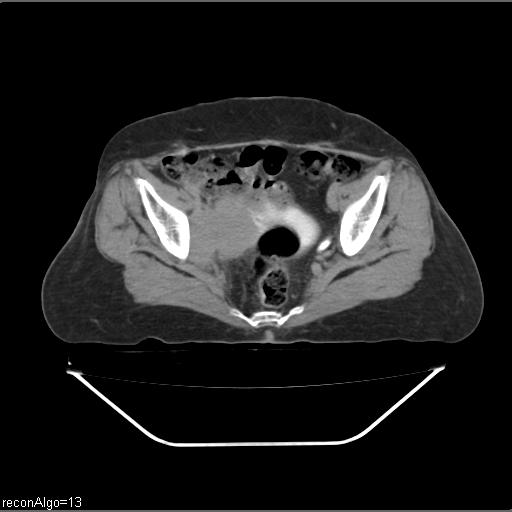 File:Carcinoma cervix- recurrence (Radiopaedia 34702-36137 B 83).jpg