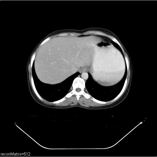 File:Carcinoma of esophagus (Radiopaedia 27356-27550 A 8).jpg