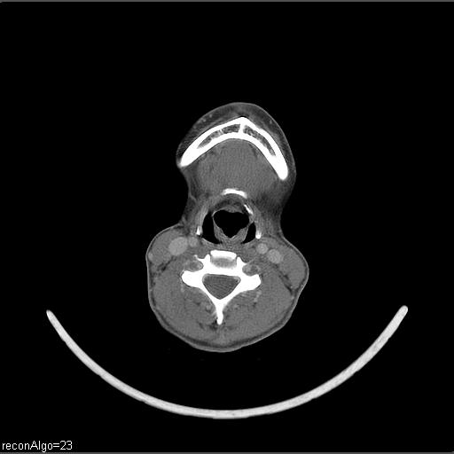 File:Carcinoma of the maxillary antrum (Radiopaedia 53805-59888 Axial C+ delayed 24).jpg