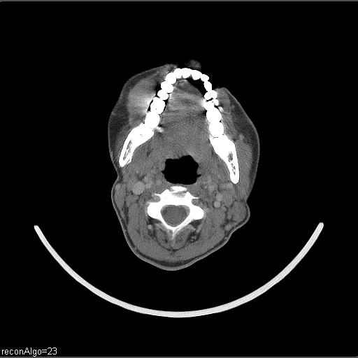 Carcinoma of the maxillary antrum (Radiopaedia 53805-59888 Axial C+ delayed 36).jpg