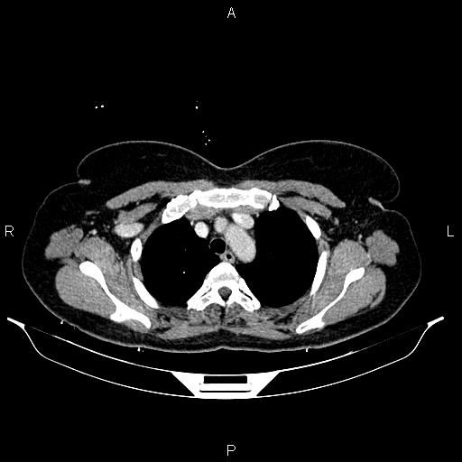 Carcinoma of uterine cervix (Radiopaedia 85861-101700 A 11).jpg
