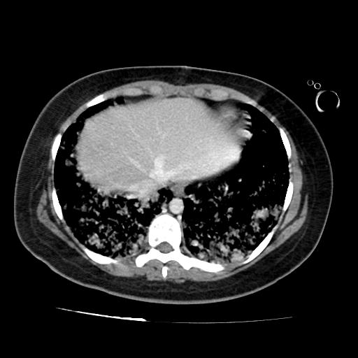 File:Cardiac angiosarcoma (Radiopaedia 66010-75181 B 73).jpg