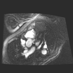 File:Cardiac fibroma (Radiopaedia 38974-41150 4 chamber FGRET 3).jpg