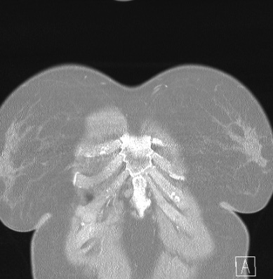 Cardiac sarcoidosis (Radiopaedia 74548-85534 Coronal lung window 1).jpg