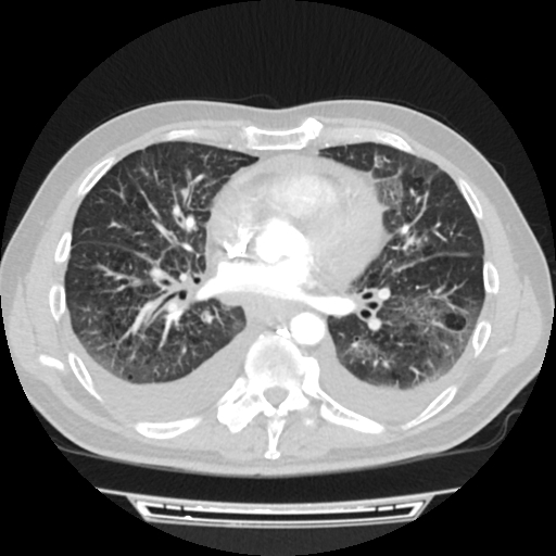 Cardiac tamponade (Radiopaedia 78607-91368 Axial lung window 50).jpg