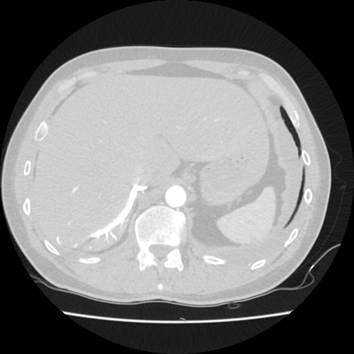 Cardiac tamponade (Radiopaedia 78607-91368 Axial lung window 92).jpg