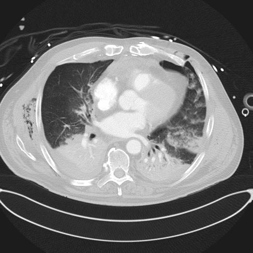 File:Cardiac trauma (Radiopaedia 32874-33858 Axial lung window 32).jpg