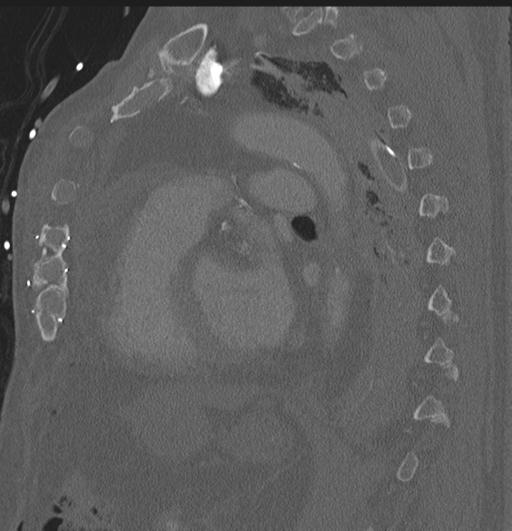 Cardiac trauma (Radiopaedia 32874-33858 Sagittal bone window 16).jpg