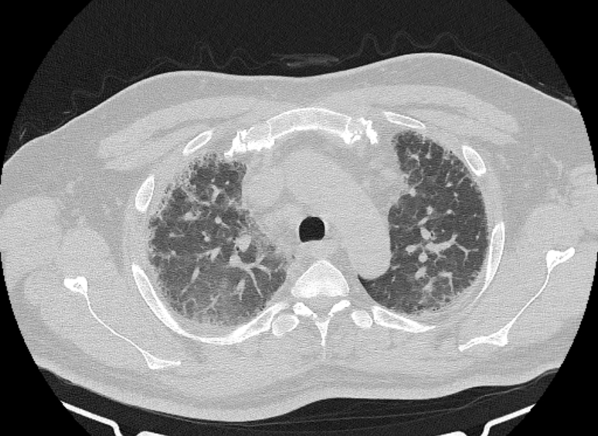 Cardiogenic pulmonary edema (Radiopaedia 68180-77678 Axial lung window 20).jpg