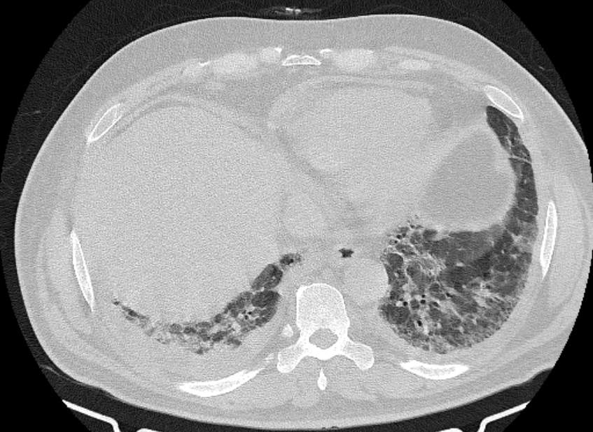Cardiogenic pulmonary edema (Radiopaedia 68180-77678 Axial lung window 79).jpg