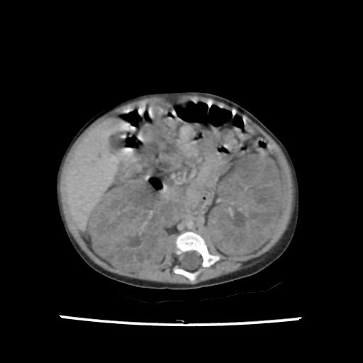 Caroli disease with autosomal recessive polycystic kidney disease (ARPKD) (Radiopaedia 89651-106703 B 118).jpg