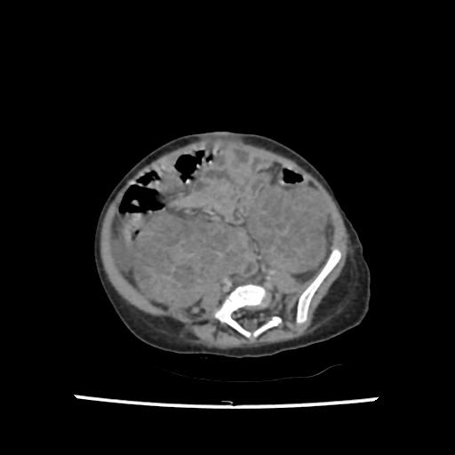 Caroli disease with autosomal recessive polycystic kidney disease (ARPKD) (Radiopaedia 89651-106703 B 160).jpg