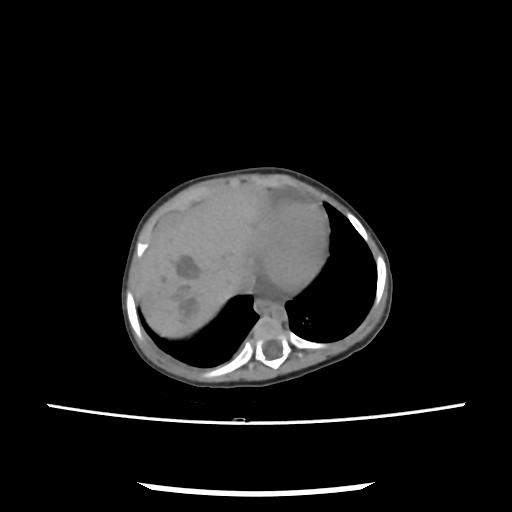 Caroli disease with autosomal recessive polycystic kidney disease (ARPKD) (Radiopaedia 89651-106703 E 16).jpg