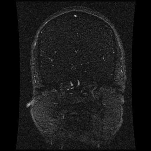 Carotid arterial dissection with acute cerebral infarction (Radiopaedia 26636-26784 MRV 99).jpg