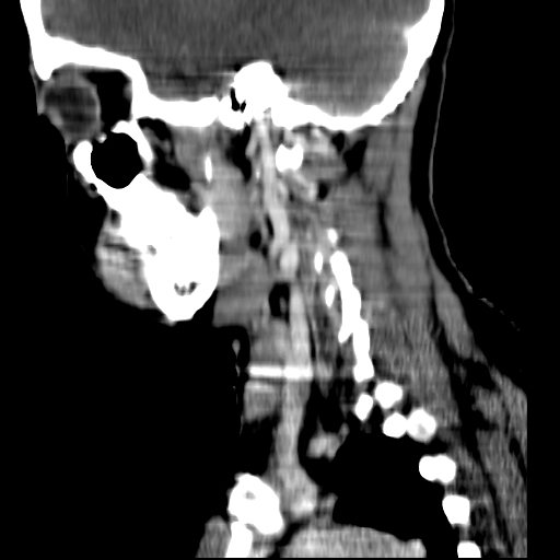 File:Carotid body tumor (Radiopaedia 27890-28124 C 5).jpg