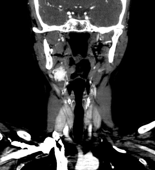 File:Carotid body tumor (Radiopaedia 39845-42300 C 9).jpg