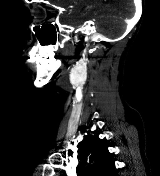 File:Carotid body tumor (Radiopaedia 39845-42300 D 32).jpg