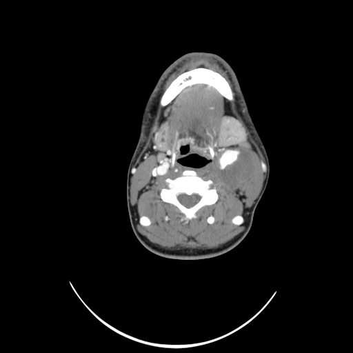 Carotid bulb pseudoaneurysm (Radiopaedia 57670-64616 A 34).jpg