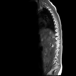 File:Caudal regression syndrome (Radiopaedia 61990-70072 Sagittal T1 11).jpg
