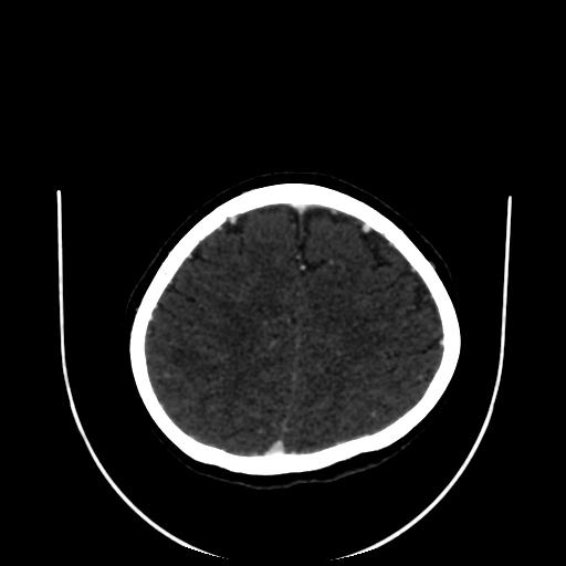 Cavernoma with developmental venous anomaly (Radiopaedia 22470-22506 C 150).jpg