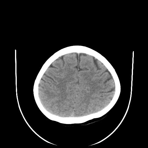 File:Cavernoma with developmental venous anomaly (Radiopaedia 22470-22506 non-contrast 27).jpg