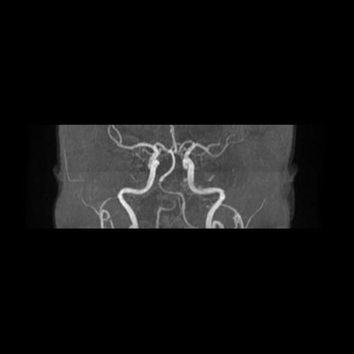 Cavernoma with developmental venous anomaly (Radiopaedia 22470-22507 MRA 9).jpg