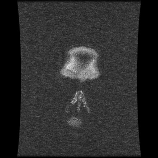 Cavernoma with developmental venous anomaly (Radiopaedia 22470-22507 MRV 124).jpg