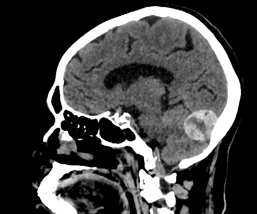 Cavernous hemangioma of the cerebellar falx (Radiopaedia 73025-83723 B 185).jpg