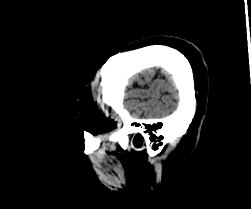 Cavernous hemangioma of the cerebellar falx (Radiopaedia 73025-83723 B 37).jpg