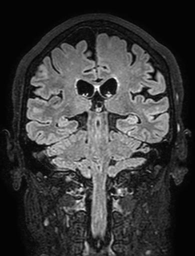 Cavernous hemangioma of the cerebellar falx (Radiopaedia 73025-83724 Coronal FLAIR 213).jpg