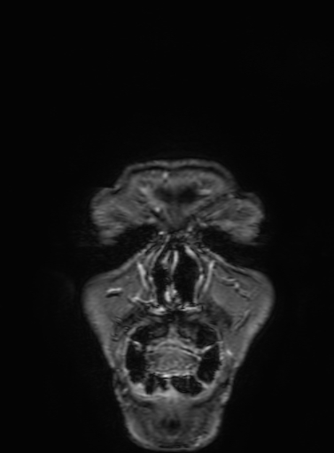 Cavernous hemangioma of the cerebellar falx (Radiopaedia 73025-83724 Coronal T1 C+ 3).jpg