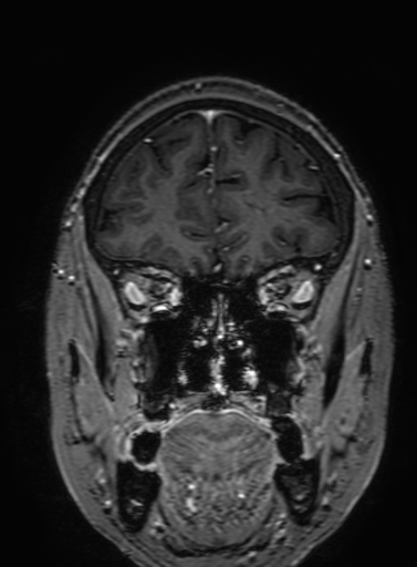 Cavernous hemangioma of the cerebellar falx (Radiopaedia 73025-83724 Coronal T1 C+ 88).jpg