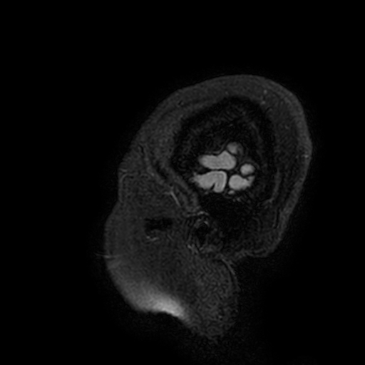 Cavernous hemangioma of the cerebellar falx (Radiopaedia 73025-83724 Sagittal FLAIR 215).jpg