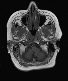File:Cavernous sinus meningioma (Radiopaedia 63682-72367 Axial T1 3).jpg
