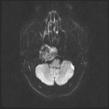 Cavernous sinus meningioma (Radiopaedia 63682-72367 DWI 45).jpg