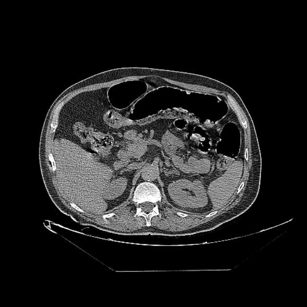 Cavitating bronchogenic carcinoma (Radiopaedia 44489-48162 Axial non-contrast 101).jpg
