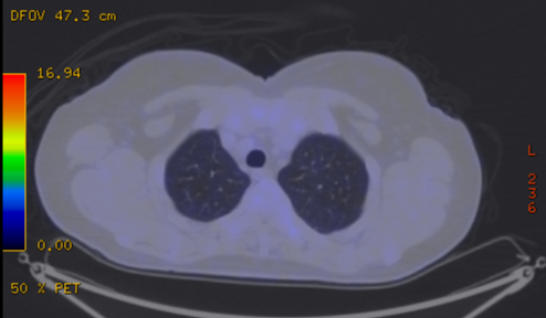 File:Cavitating lung mass - squamous cell carcinoma (Radiopaedia 48047-52853 A 21).png