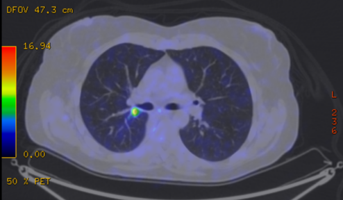 File:Cavitating lung mass - squamous cell carcinoma (Radiopaedia 48047-52853 A 42).png