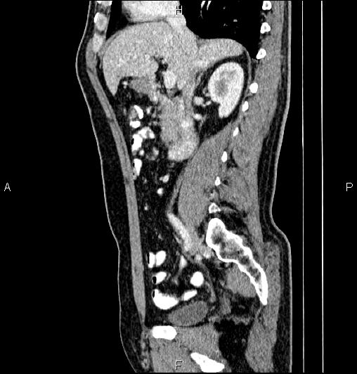 Cecal adenocarcinoma (Radiopaedia 85324-100916 E 36).jpg