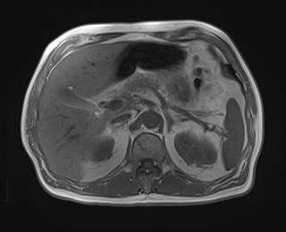 File:Cecal mass causing appendicitis (Radiopaedia 59207-66532 Axial T1 in-phase 43).jpg