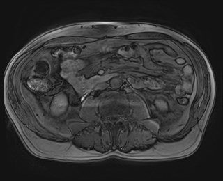 Cecal mass causing appendicitis (Radiopaedia 59207-66532 K 73).jpg