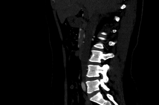 Celiac artery compression syndrome (Radiopaedia 47538-52152 B 3).jpg