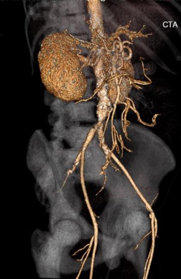 File:Celiac artery severe stenosis and dissection (Radiopaedia 44128-47842 C+ arterial phase 5).jpg