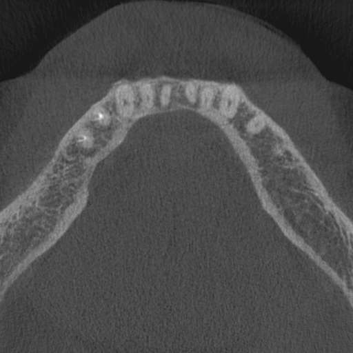 Cemento-osseous dysplasia (Radiopaedia 48251-53126 Axial non-contrast 28).jpg