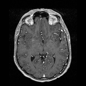 Central-variant posterior reversible encephalopathy syndrome (PRES) (Radiopaedia 43880-47358 Axial T1 C+ 74).jpg