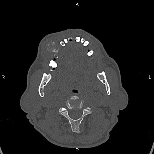 Central giant cell granuloma (Radiopaedia 83346-97761 Axial bone window 9).jpg